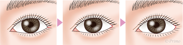 蒙古襞修正 ビフォーアフター